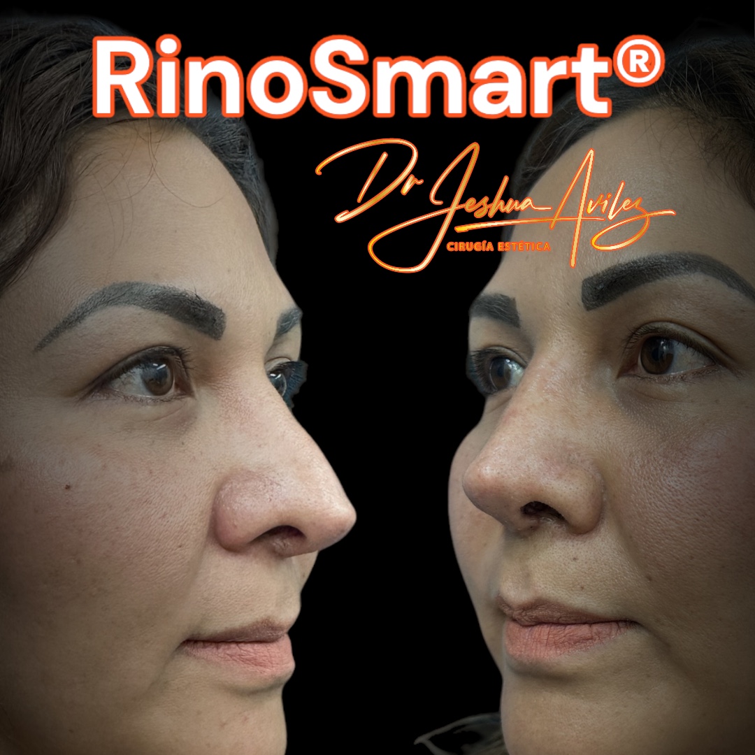 Antes y después de rinoplastia