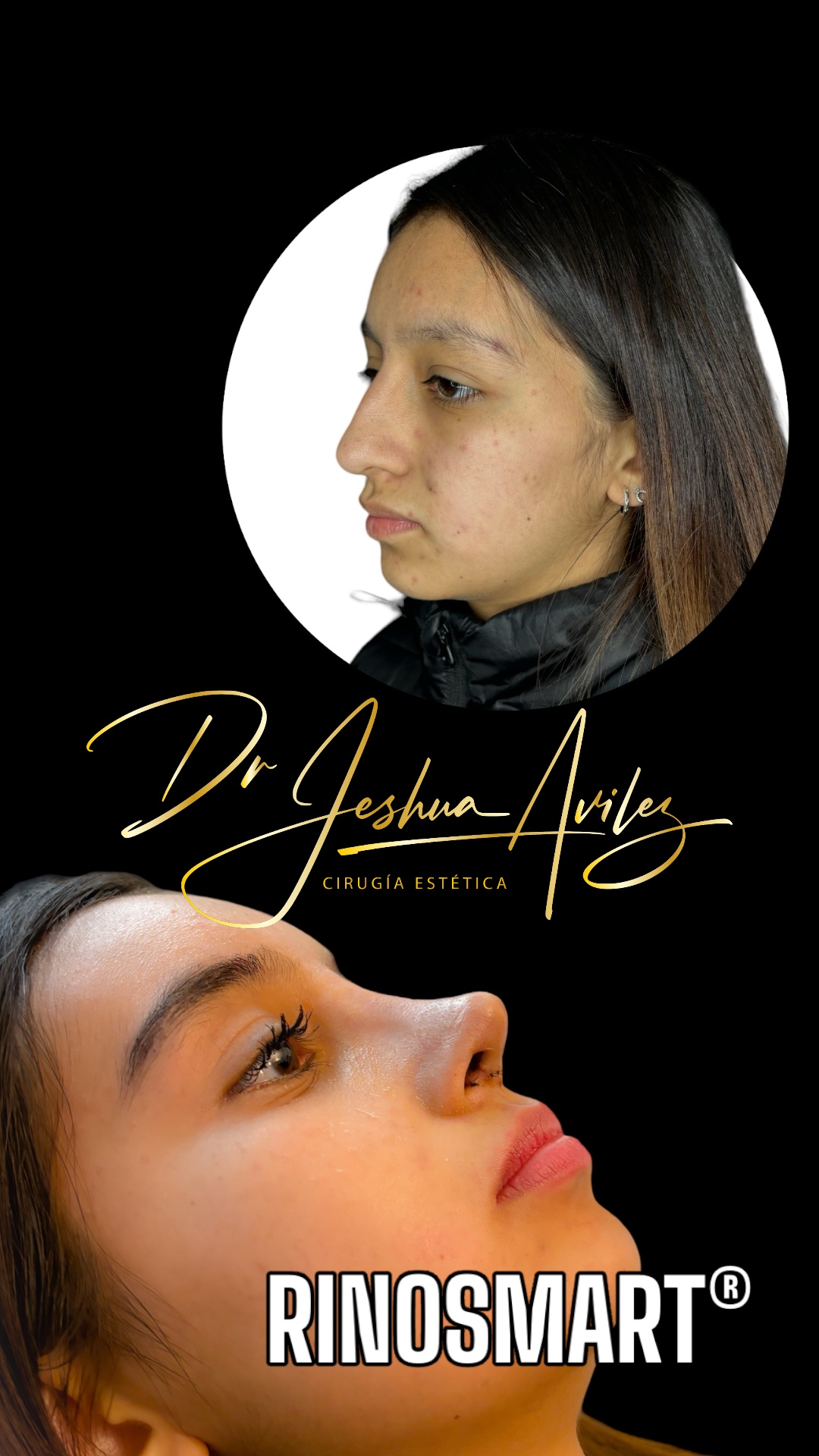 Antes y después de rinoplastia